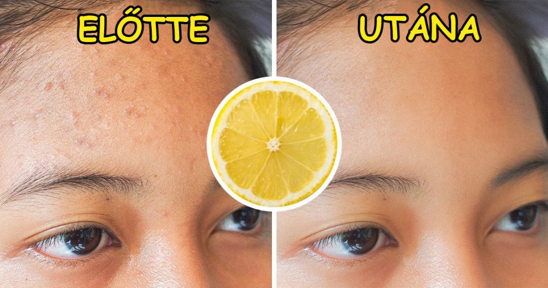 7 SZUPERÉTEL, AMELY ELMULASZTHATJA A PATTANÁSOK OKOZTA SEBEKET 7 SZUPERÉTEL, AMELY ELMULASZTHATJA A PATTANÁSOK OKOZTA SEBEKET