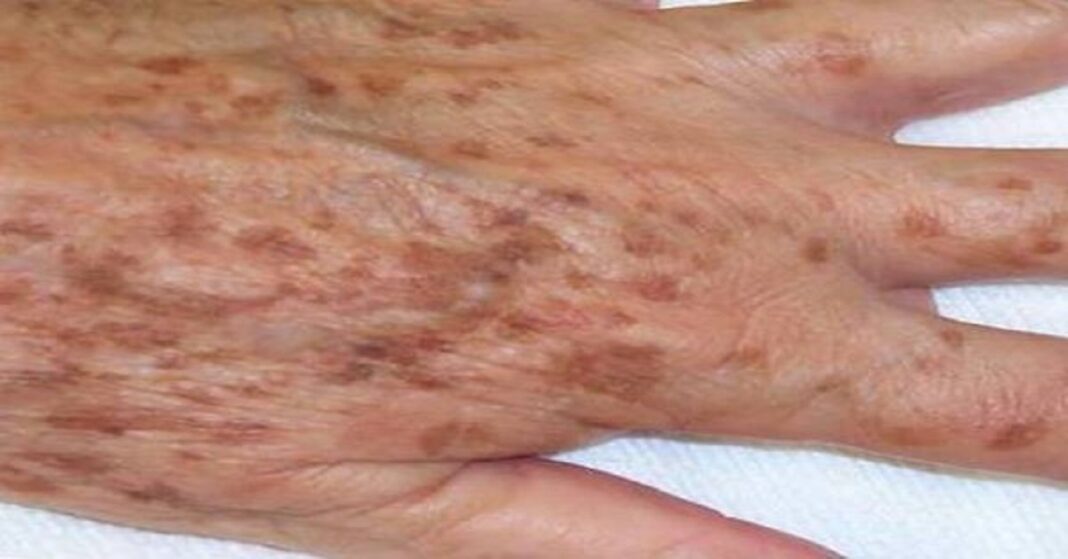 Amiről sokan nem tudnak: ezt jelzik valójában az öregedési foltok Amiről sokan nem tudnak: ezt jelzik valójában az öregedési foltok